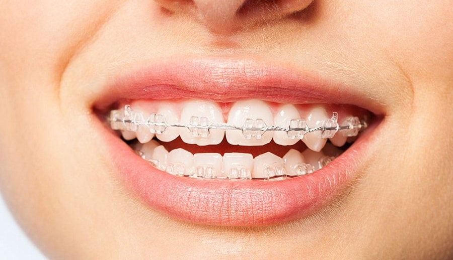 How to know what to avoid while wearing braces